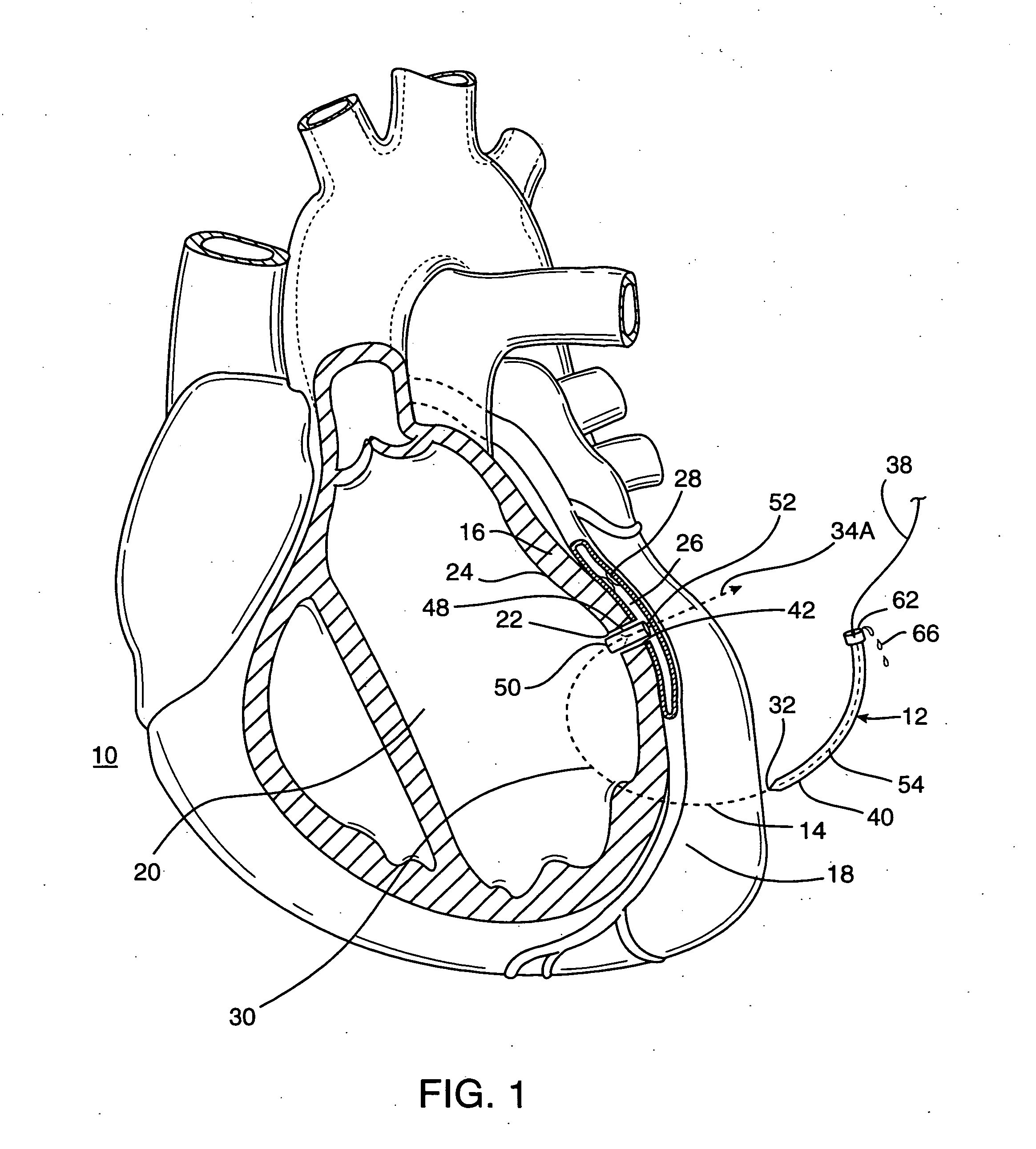 Methods and devices providing transmyocardial blood flow to the arterial vascular system of the heart
