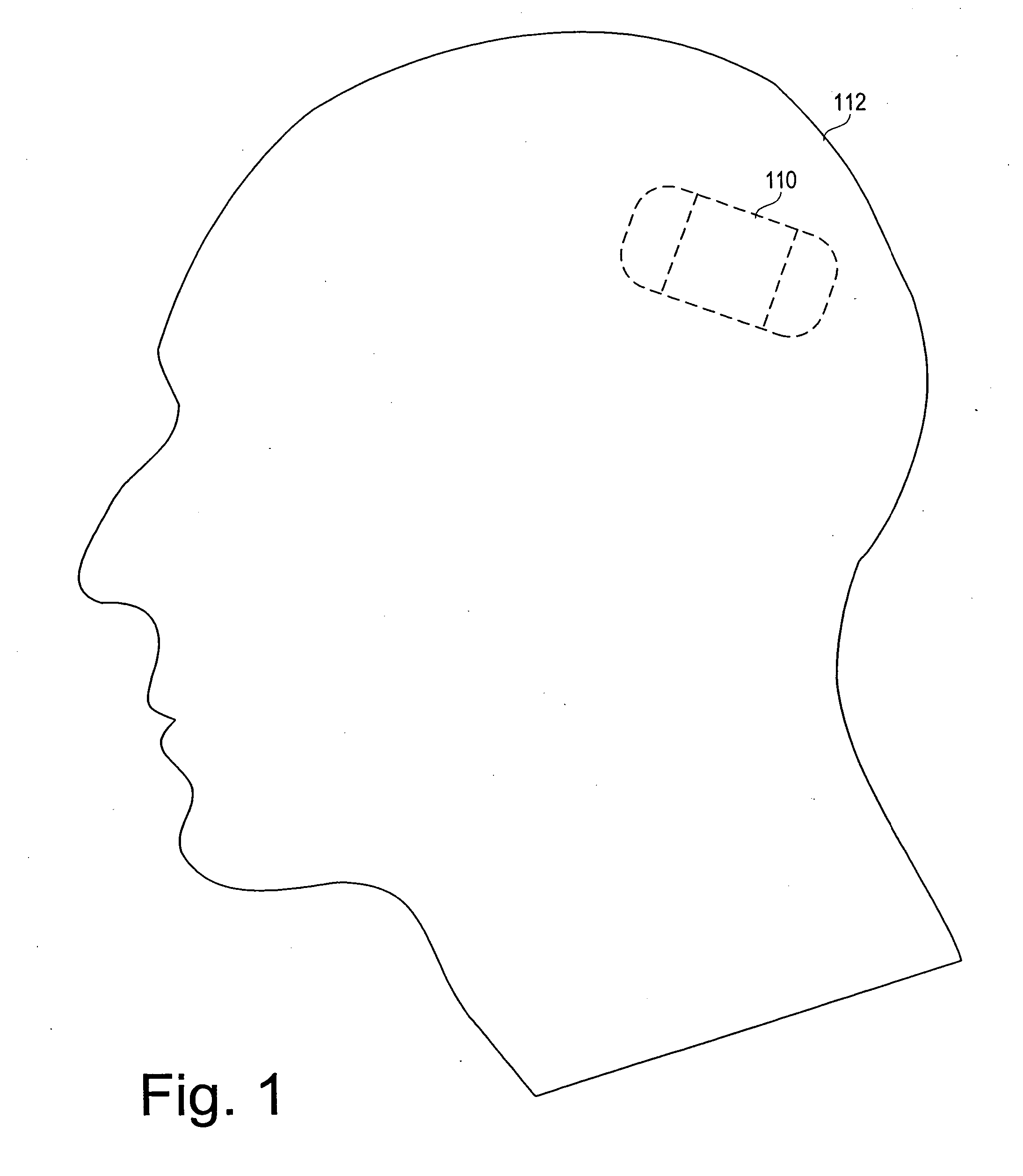 System and method for controlling neurological disorders with spatially separated detection and therapy locations