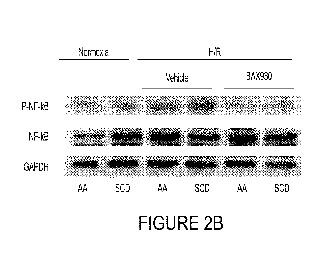 Use of adamts13 for treating, ameliorating and/or preventing vaso-occlusive crisis in sickle cell disease, acute lung injury and/or acute respiratory distress syndrome