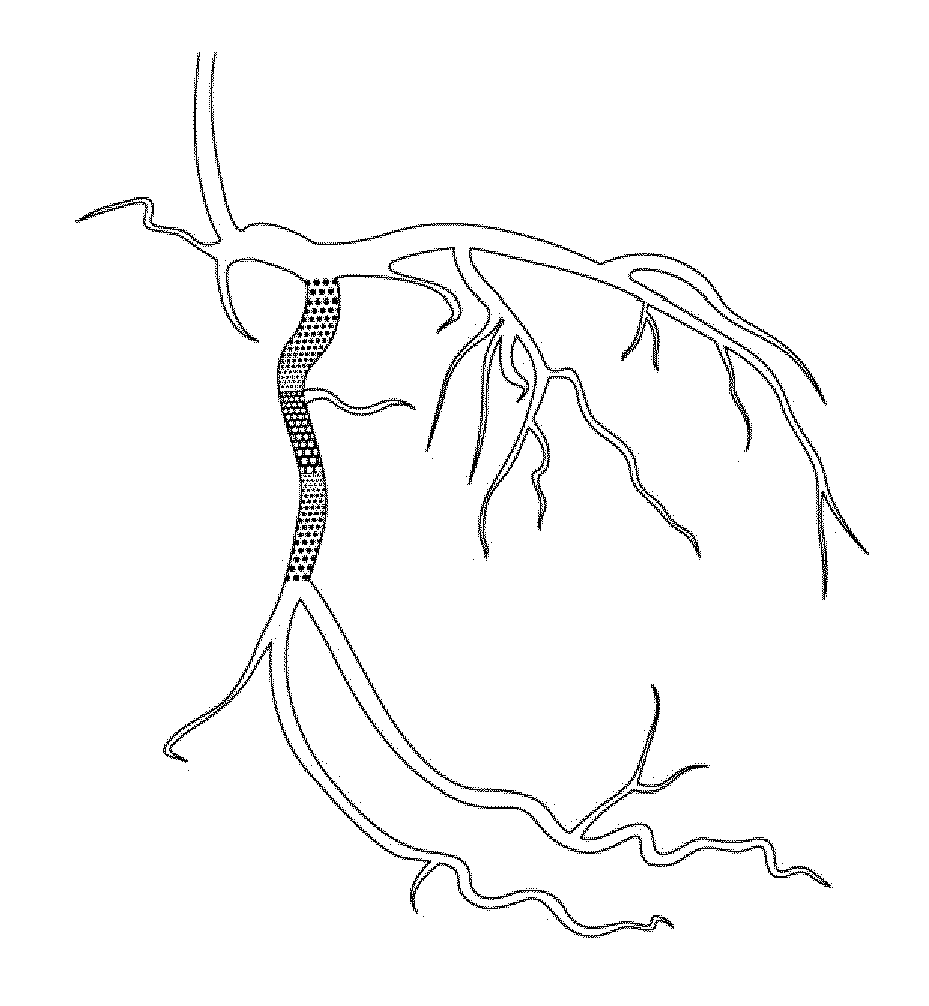 Computer-implemented method for identifying zones of stasis and stenosis in blood vessels