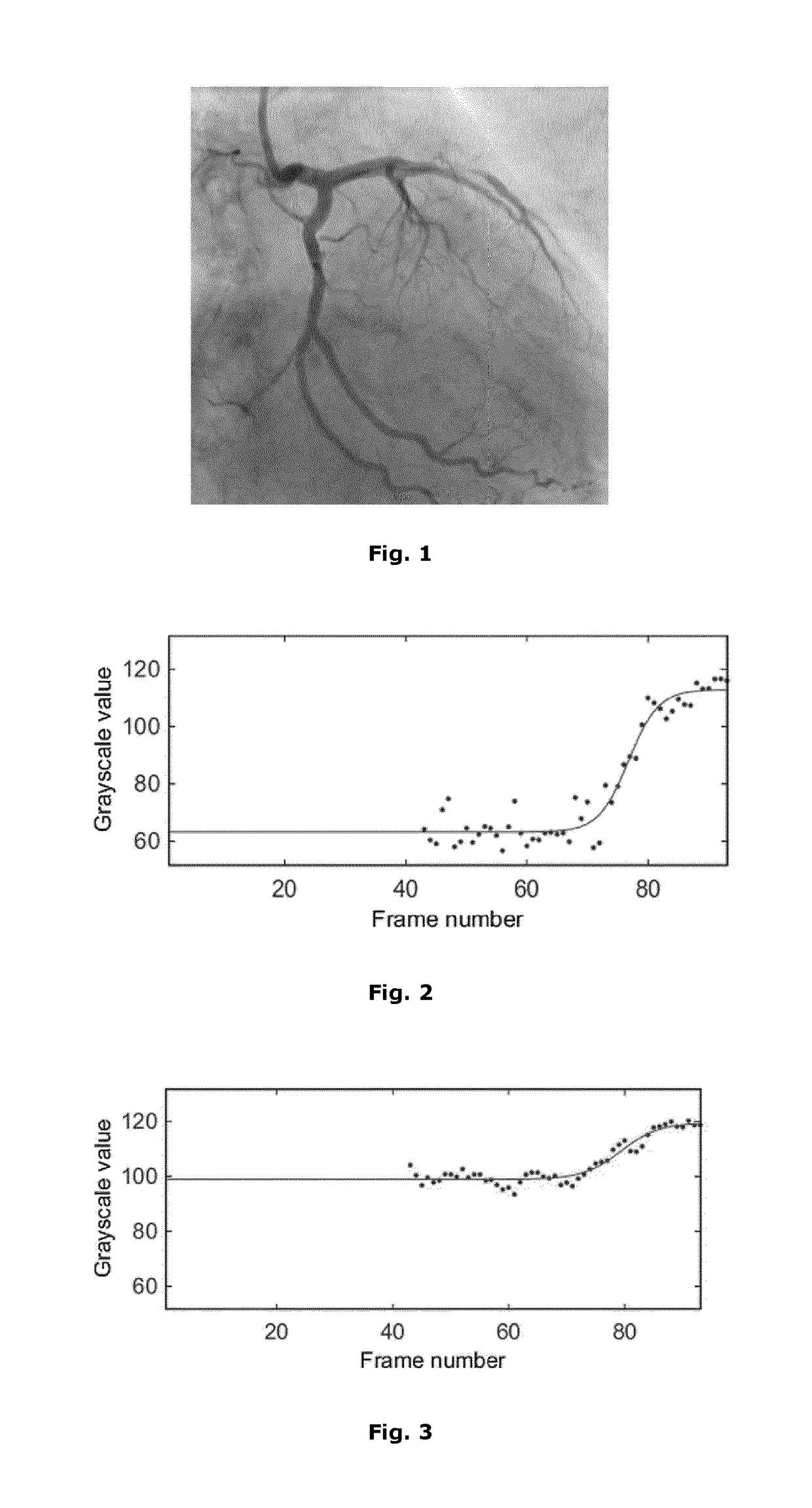 Computer-implemented method for identifying zones of stasis and stenosis in blood vessels