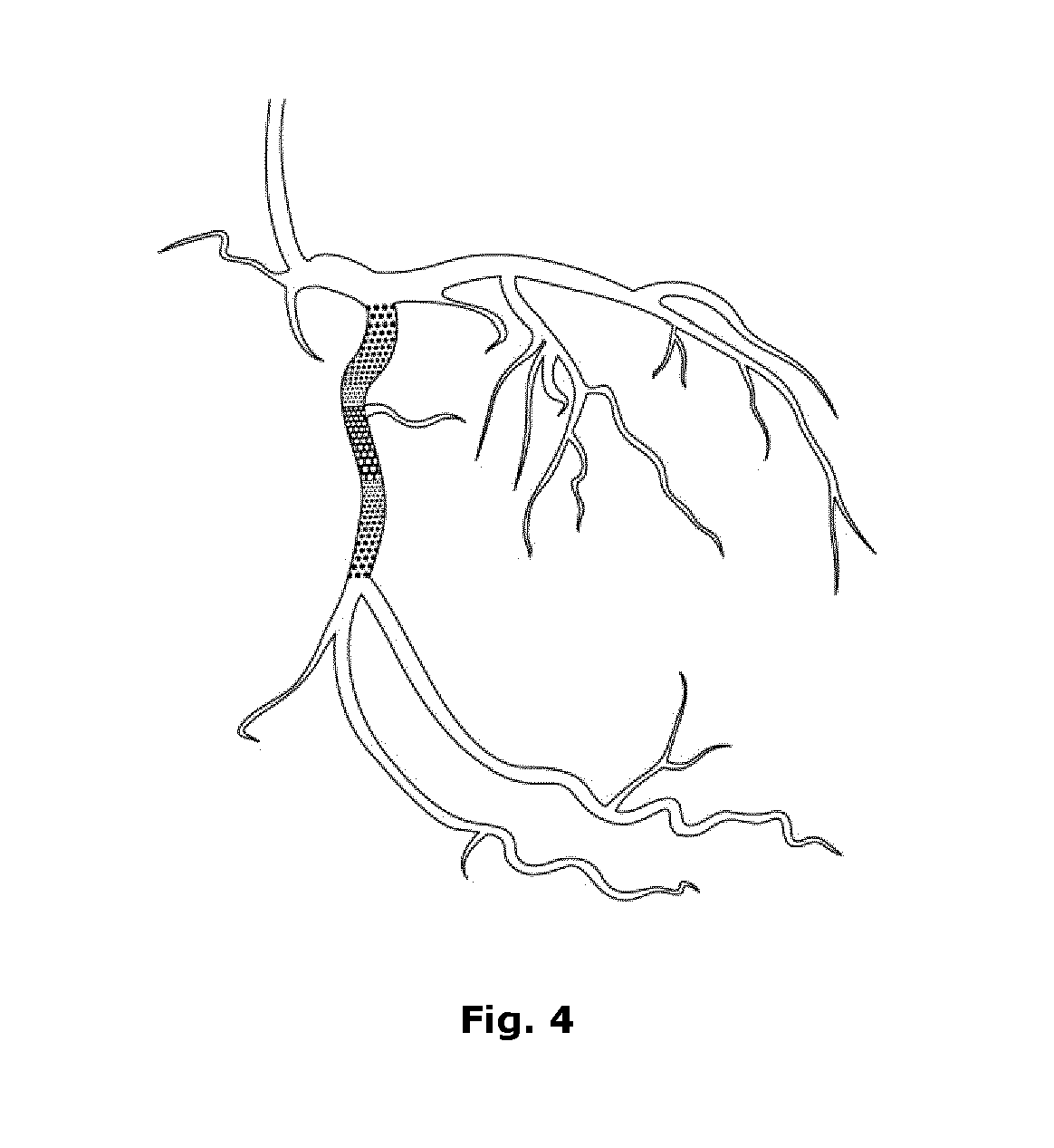 Computer-implemented method for identifying zones of stasis and stenosis in blood vessels