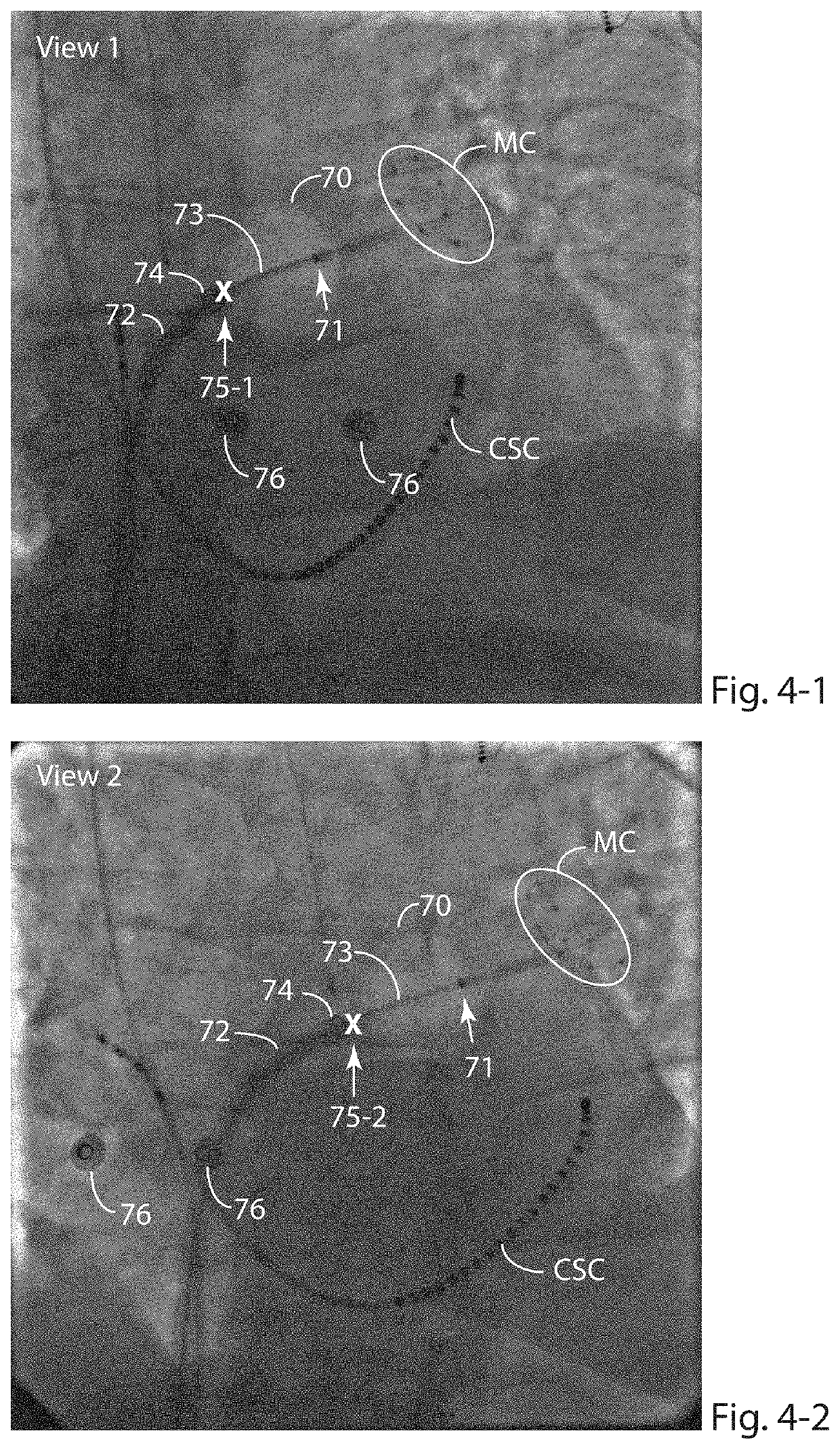 Determining and displaying the 3D location and orientation of a cardiac-ablation balloon