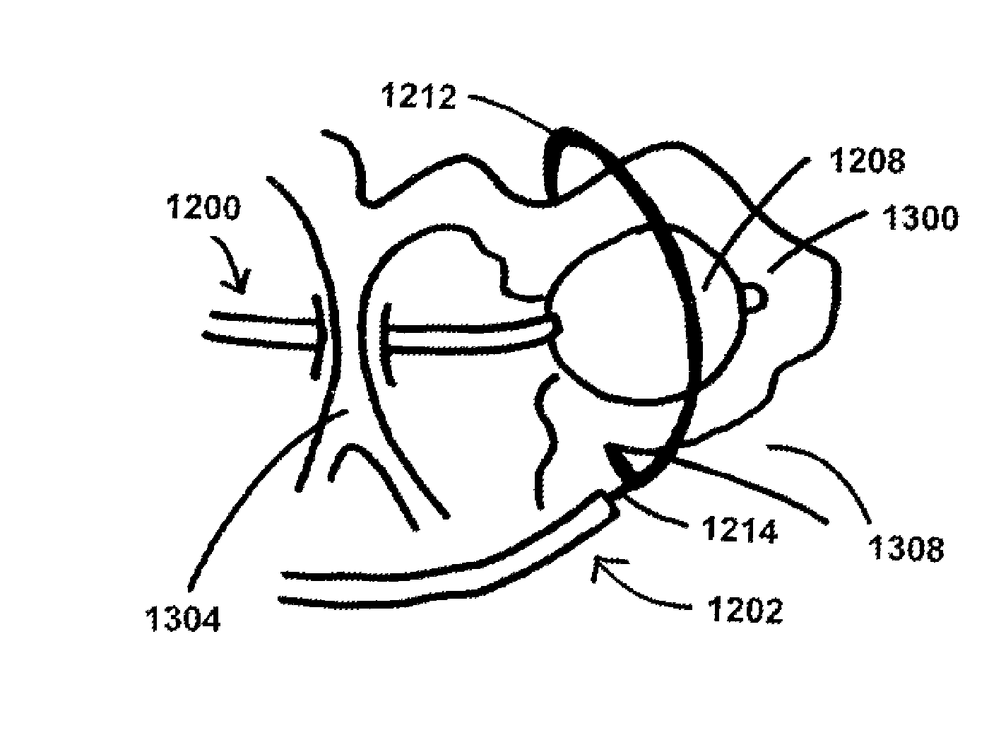 Devices, systems, and methods for percutaneous trans-septal left atrial appendage occlusion