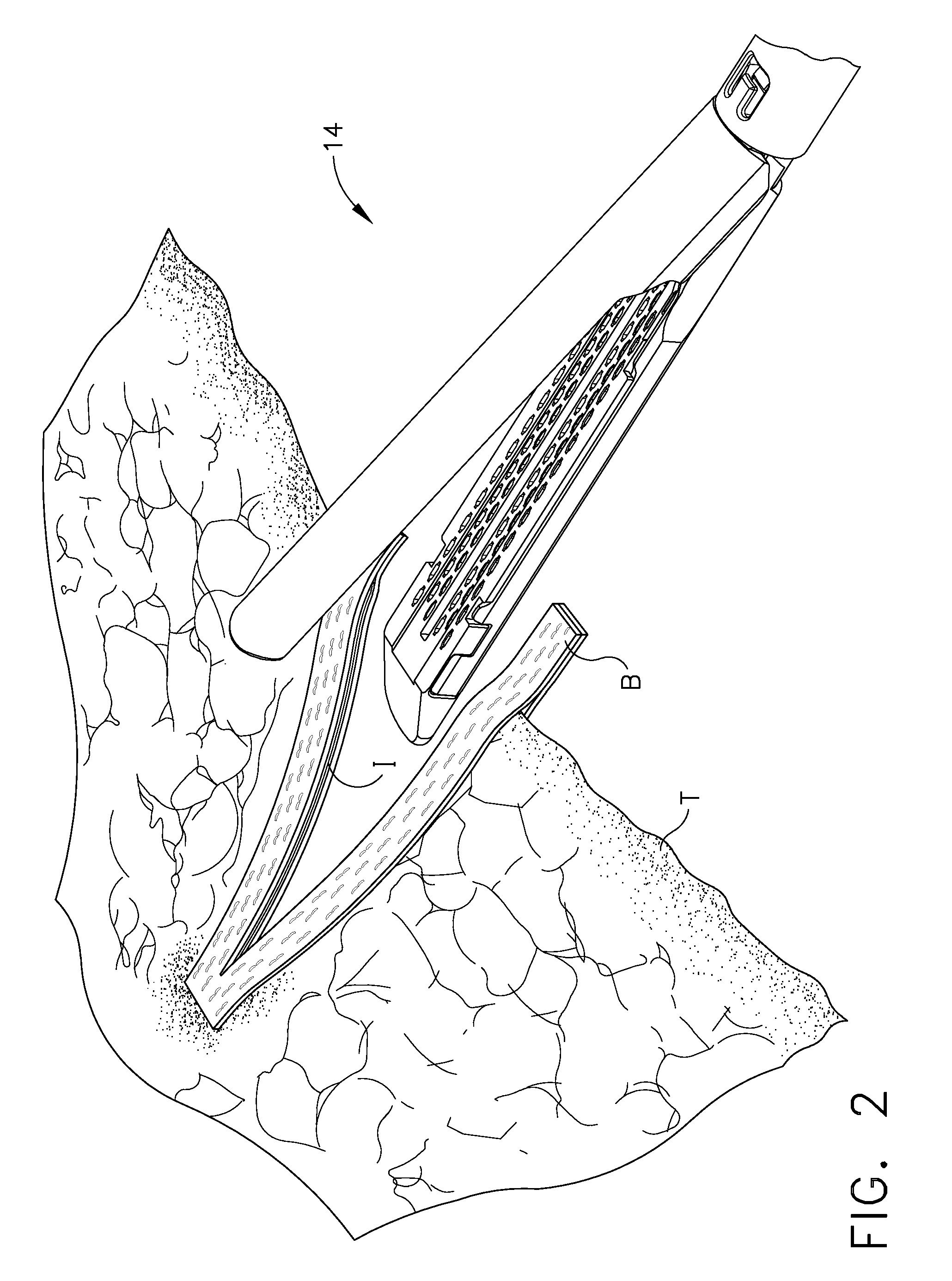 Packaging for attaching buttress material to a surgical stapling instrument