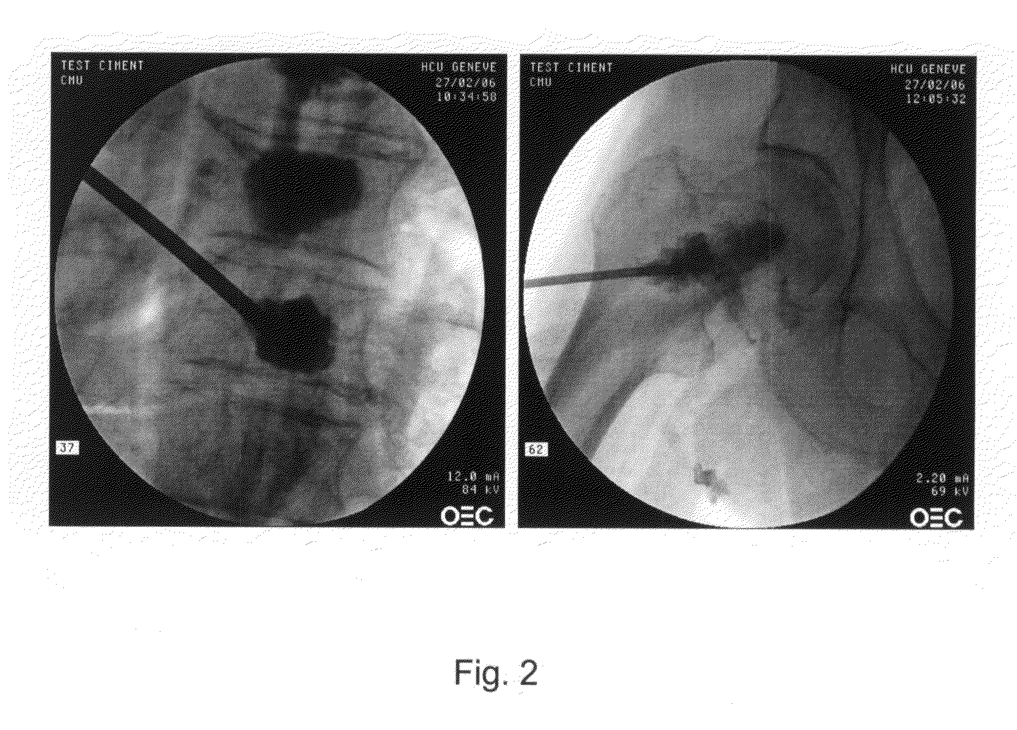 Injectable fibrin composition for bone augmentation