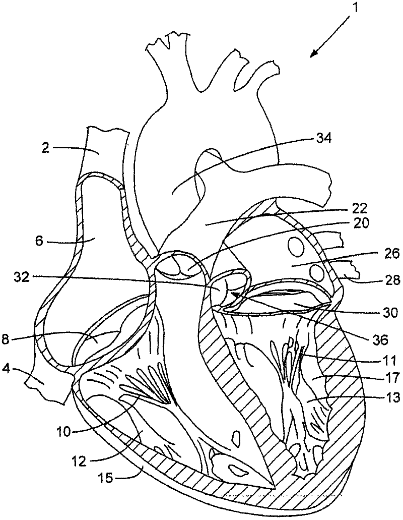 Artificial inserts to improve heart valve function