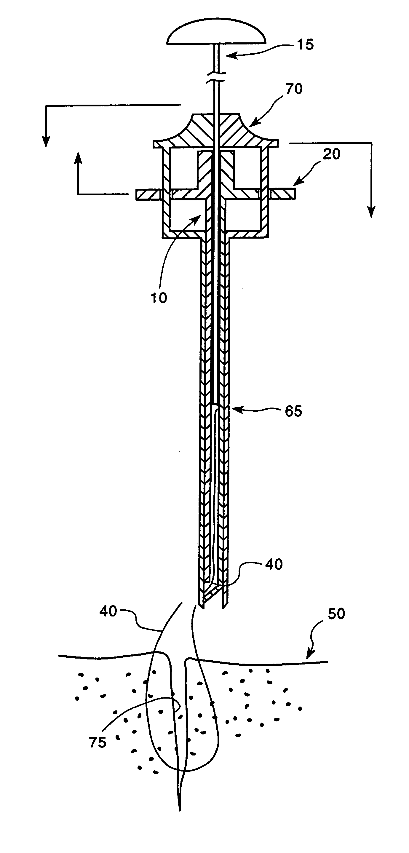 Apparatus and method for placing suture wires into tissue for the approximation and tensioning of tissue