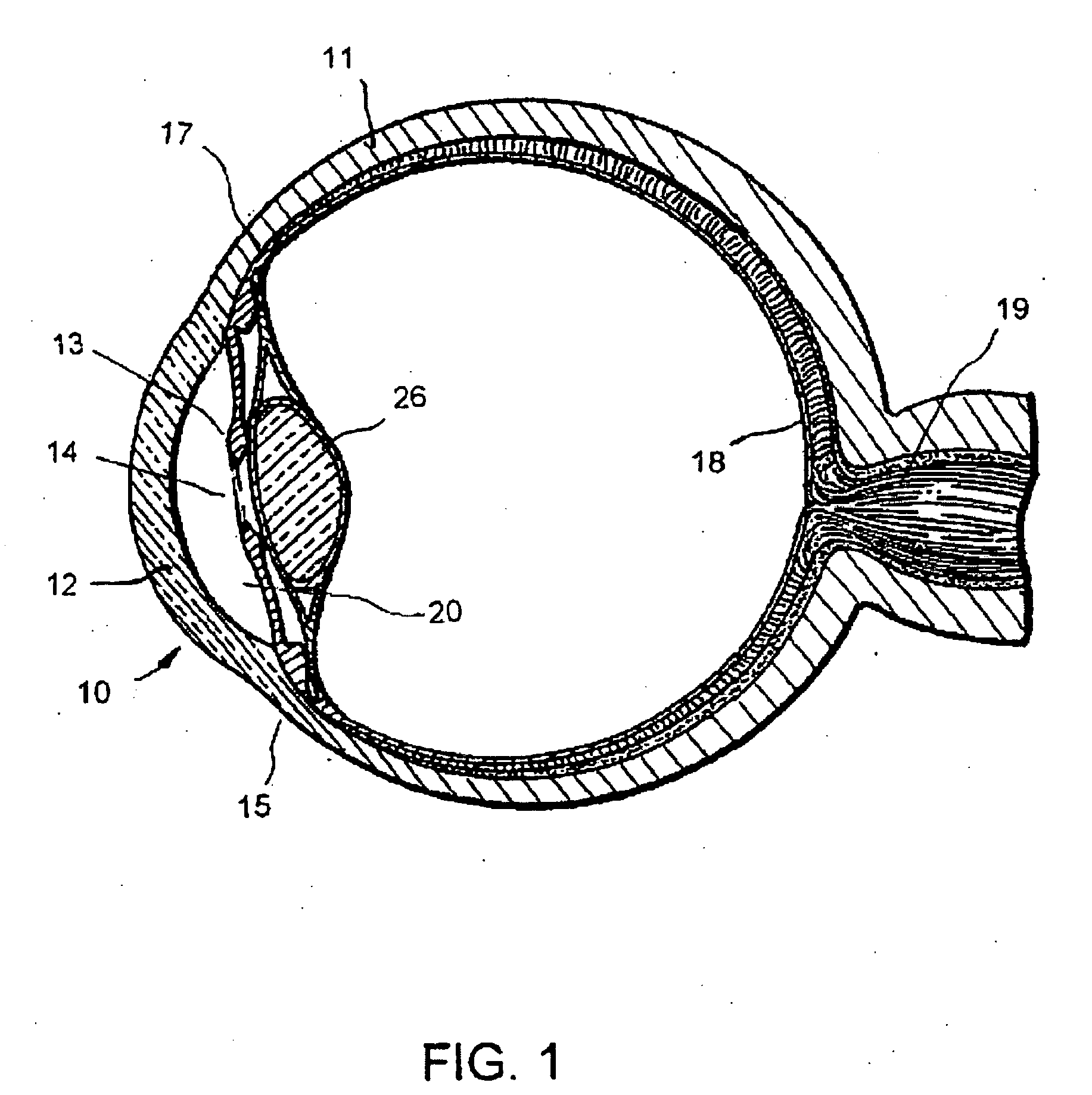 Method of treating glaucoma using an implant having a uniform diameter between the anterior chamber and Schlemm's canal