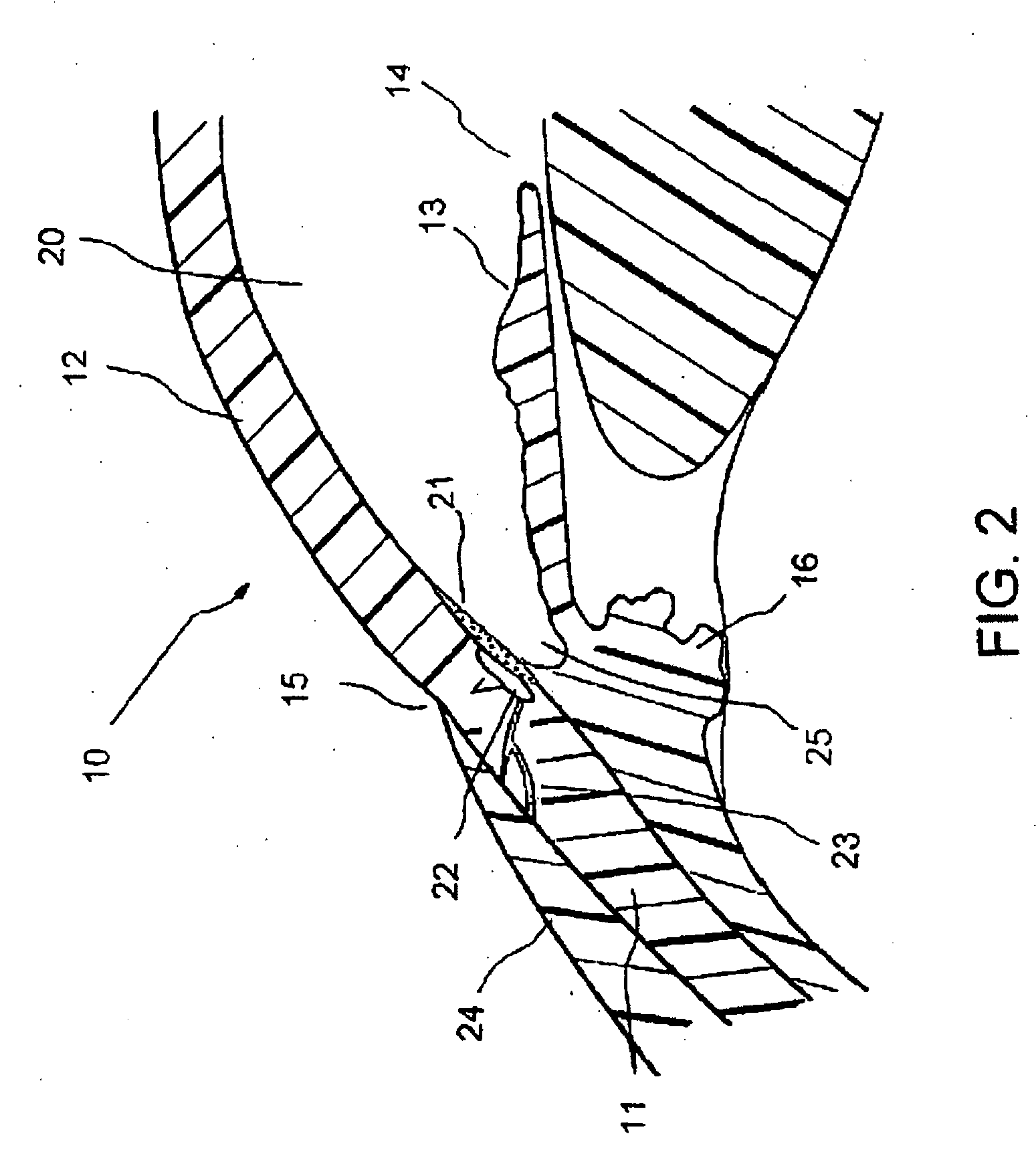 Method of treating glaucoma using an implant having a uniform diameter between the anterior chamber and Schlemm's canal