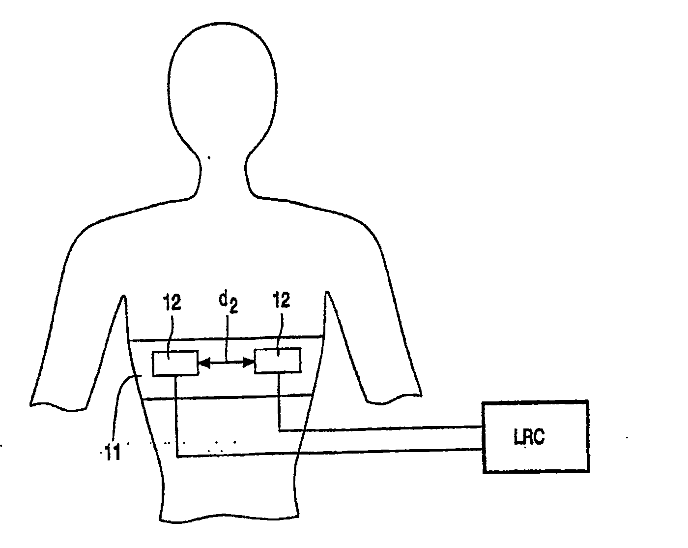 Electrode arrangement