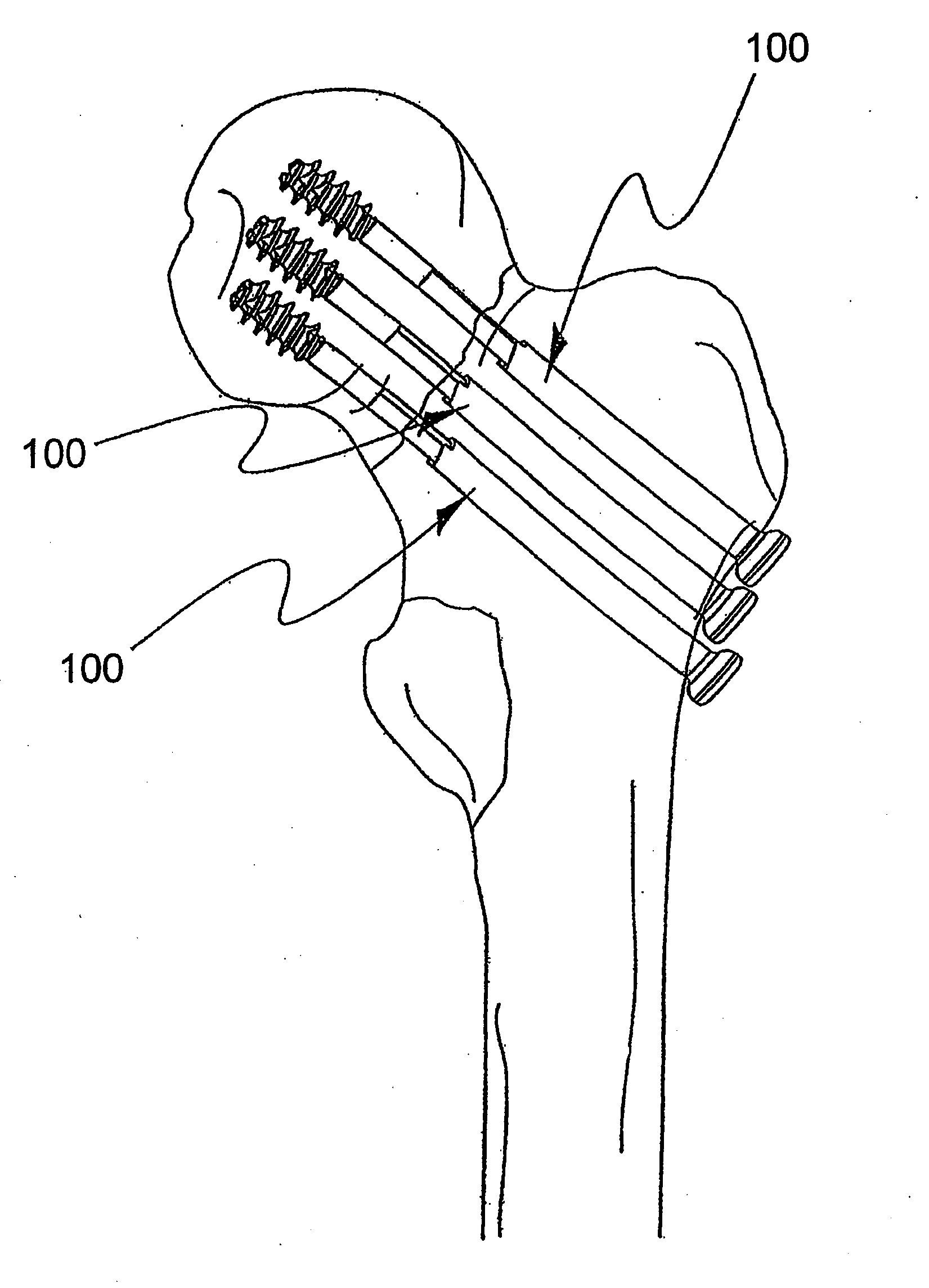 Stabilization system and method for the fixation of bone fractures