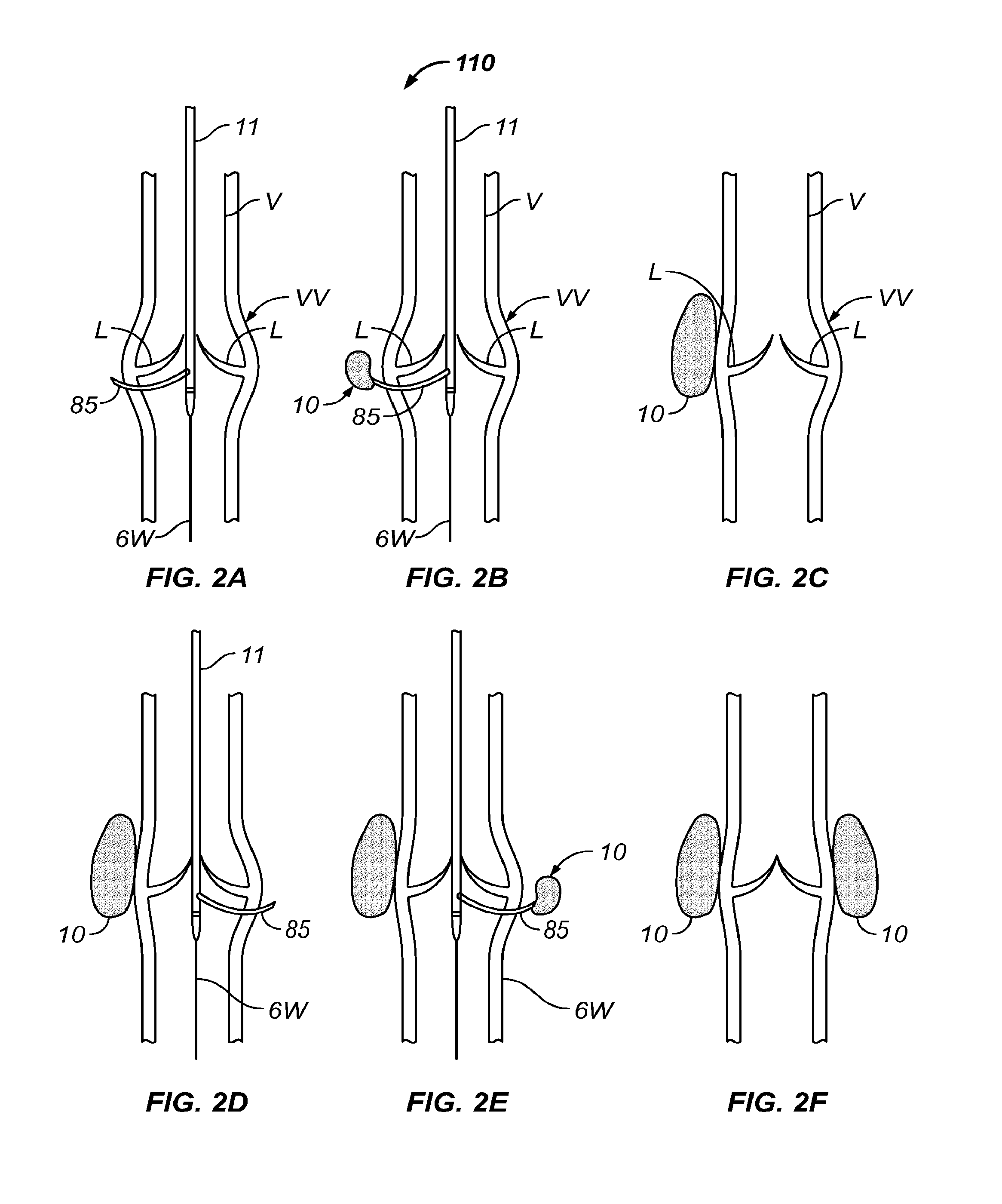 Methods, Devices and Systems for Treating Venous Insufficiency