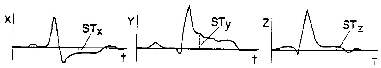 Myocardial ischemia and infarction analysis and monitoring method and apparatus