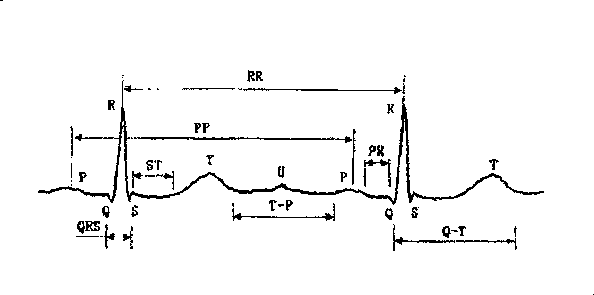 Method and apparatus for electrocardiogram recognition and specification
