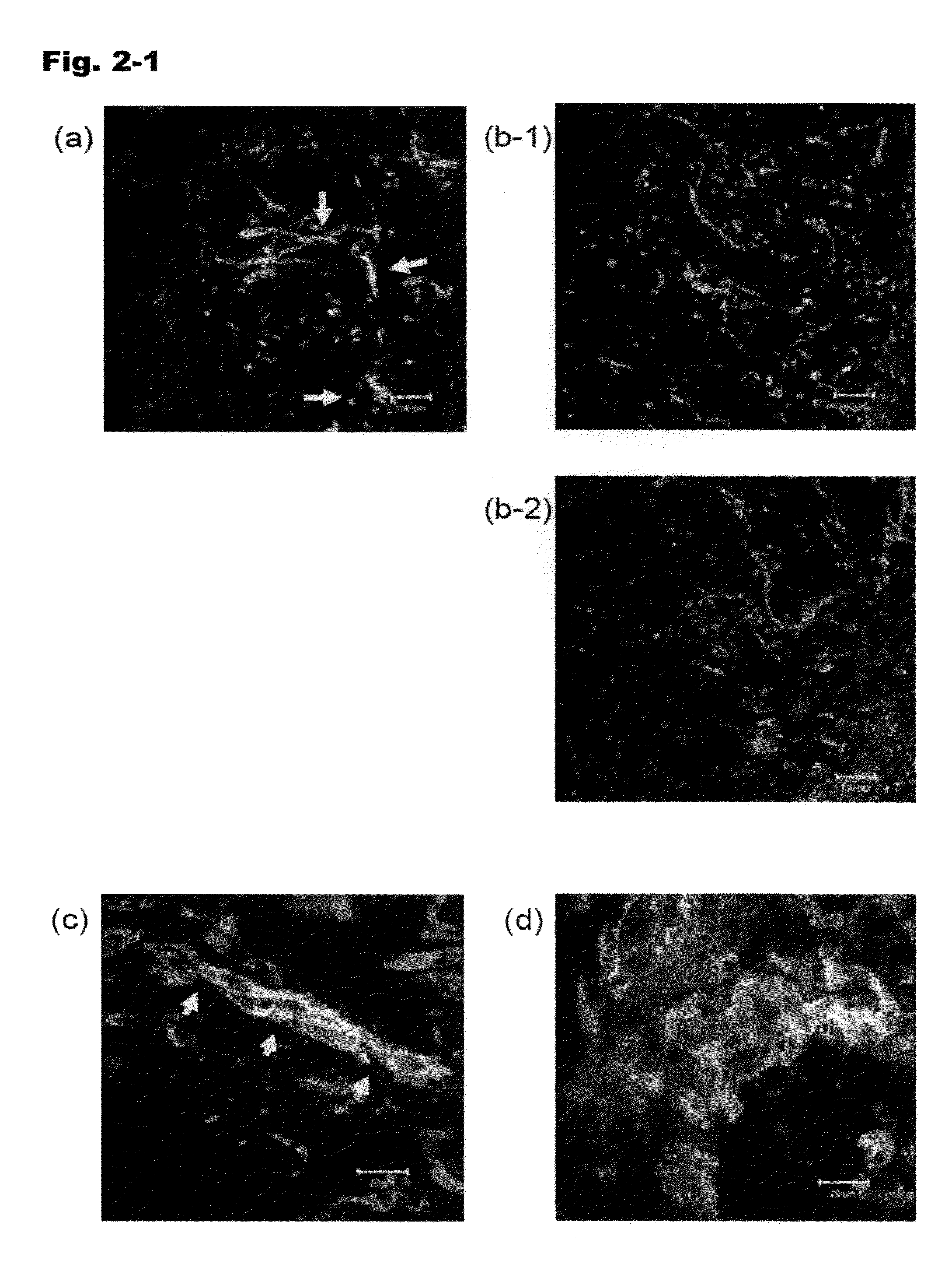 Combined use of tgf-b signaling inhibitor and antitumor agent