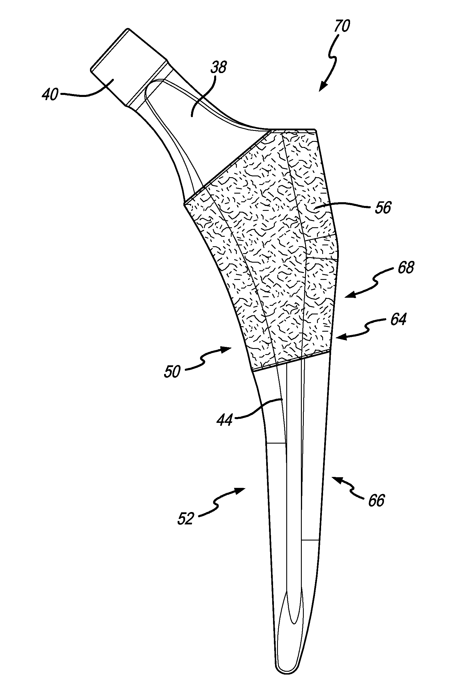 Femoral stem with partially recessed porous coating