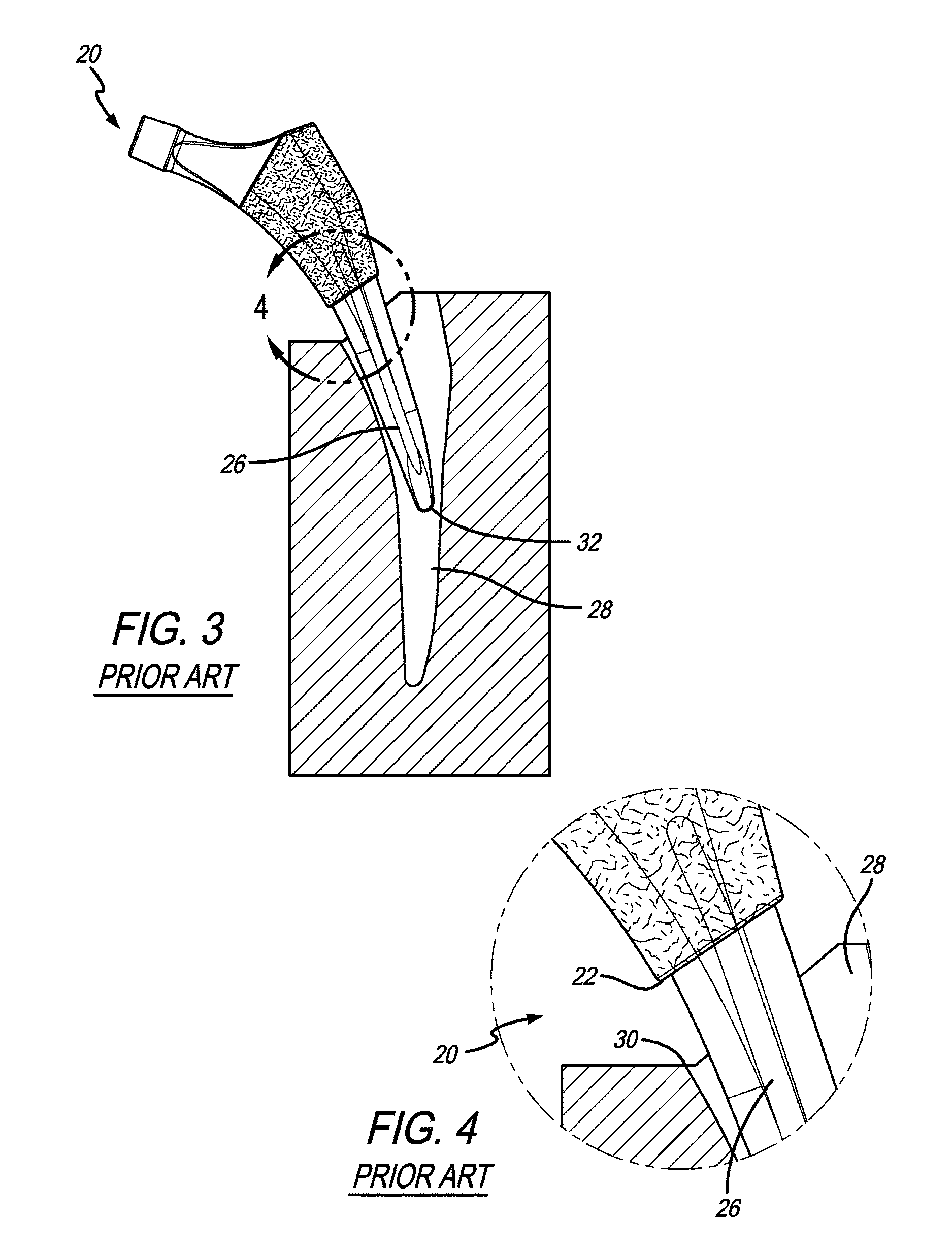 Femoral stem with partially recessed porous coating