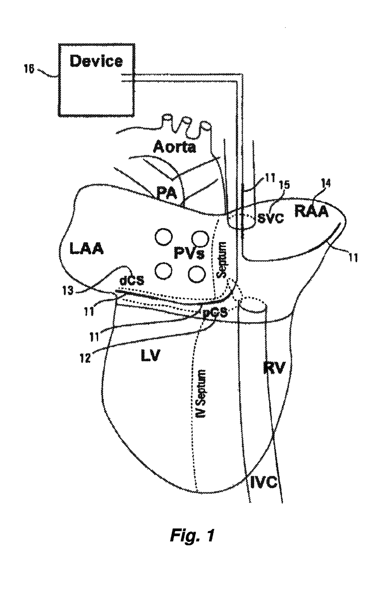 Low-energy atrial cardioversion therapy with controllable pulse-shaped waveforms