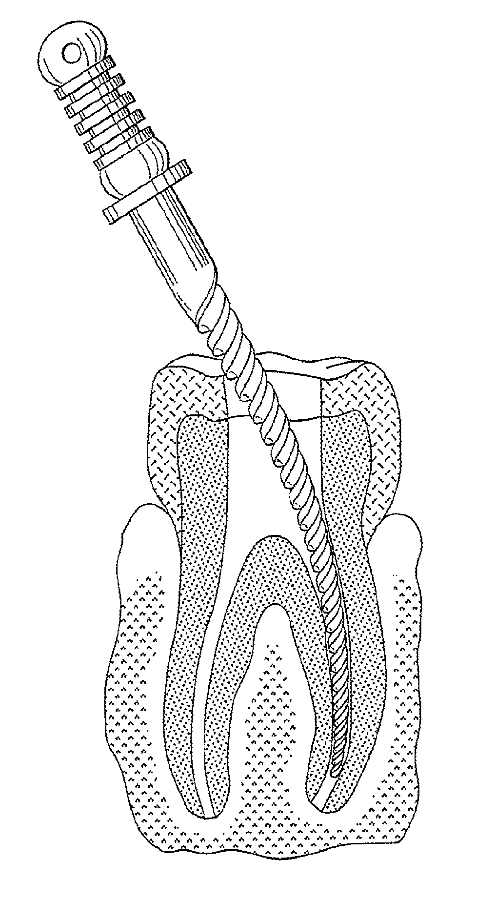 Fatigue-resistant Nitinol instrument