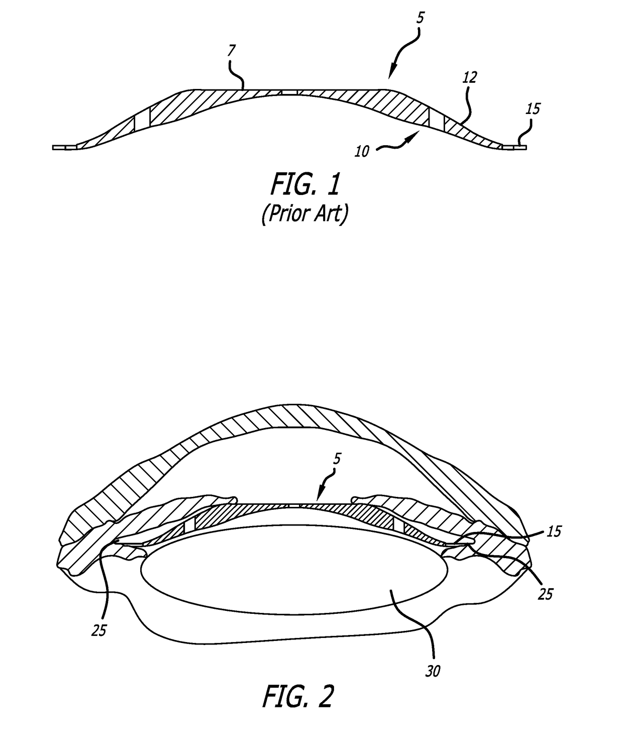 Controlled axial displacement posterior chamber phakic intraocular lens