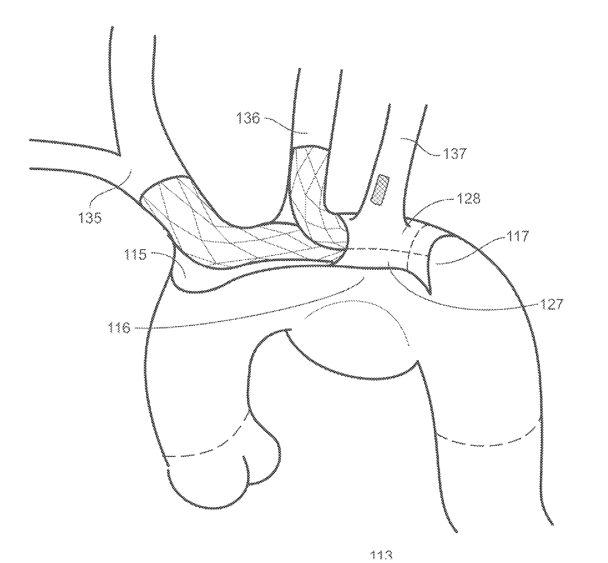 Universal endovascular grafts