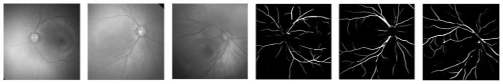 Cardiovascular surgery index risk classification method and system based on retina image