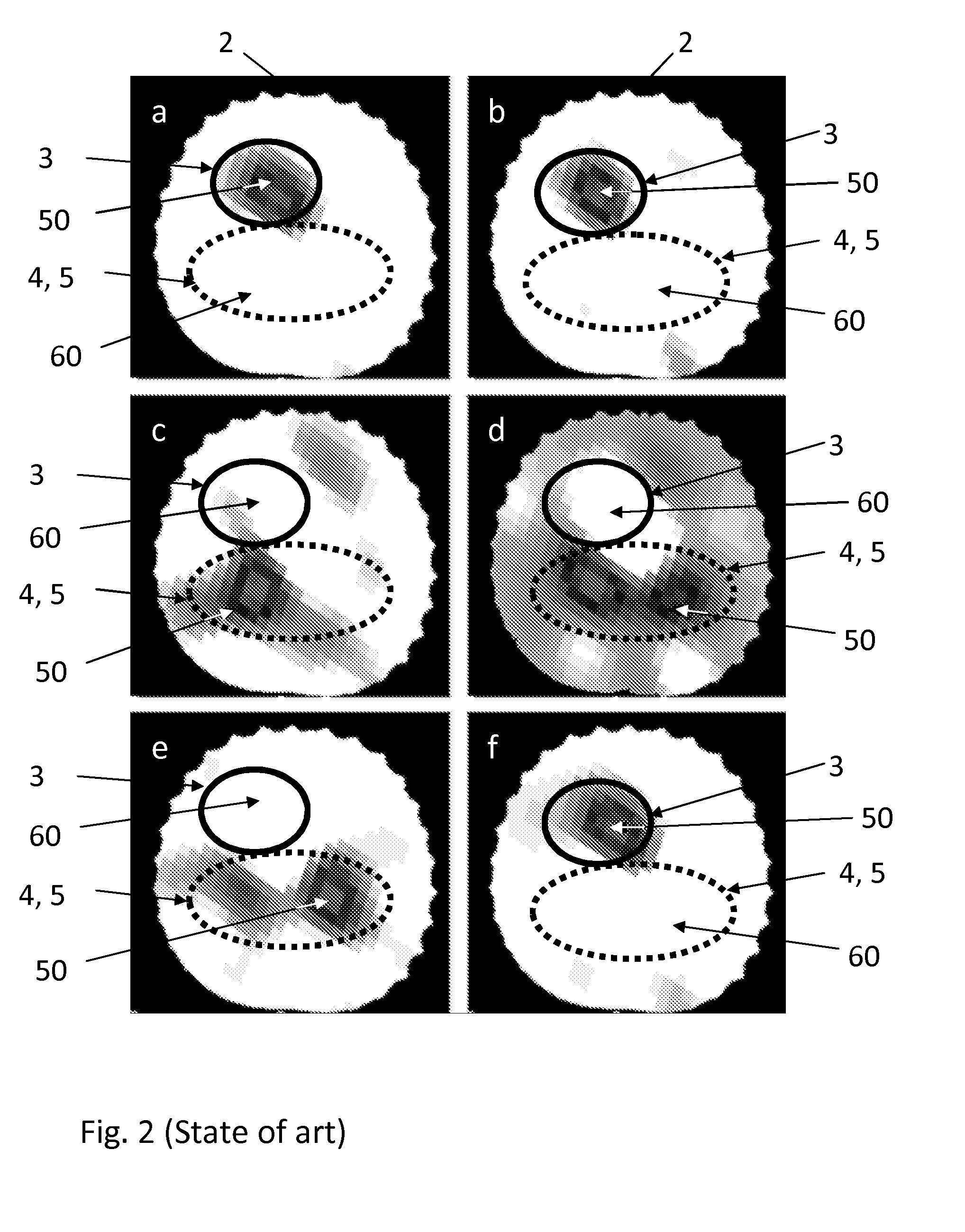 Method and Apparatus for the Non-Invasive Measurement of Pulse Transit Times (PTT)