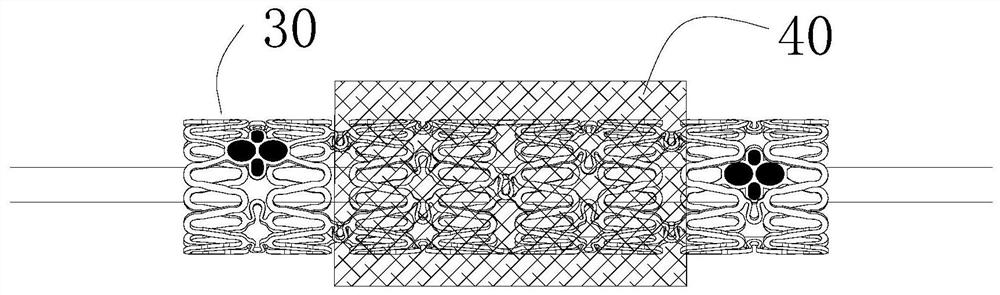 Absorbable peripheral stent and preparation method thereof