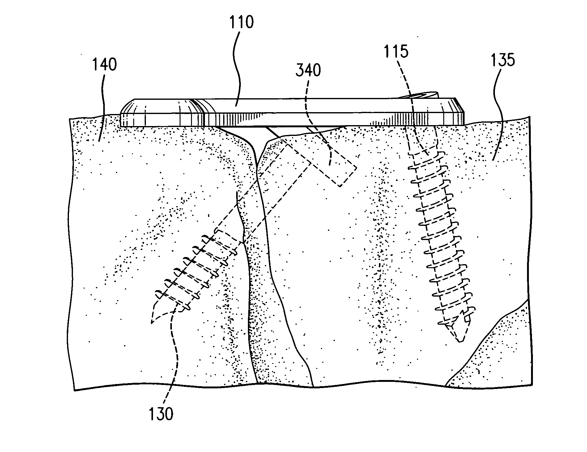 Tabbed compression plate and method of use