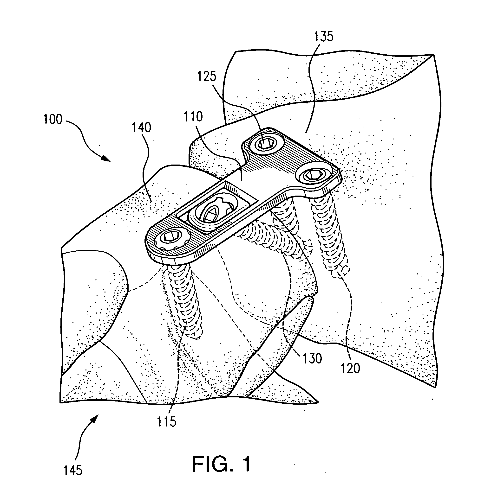 Tabbed compression plate and method of use