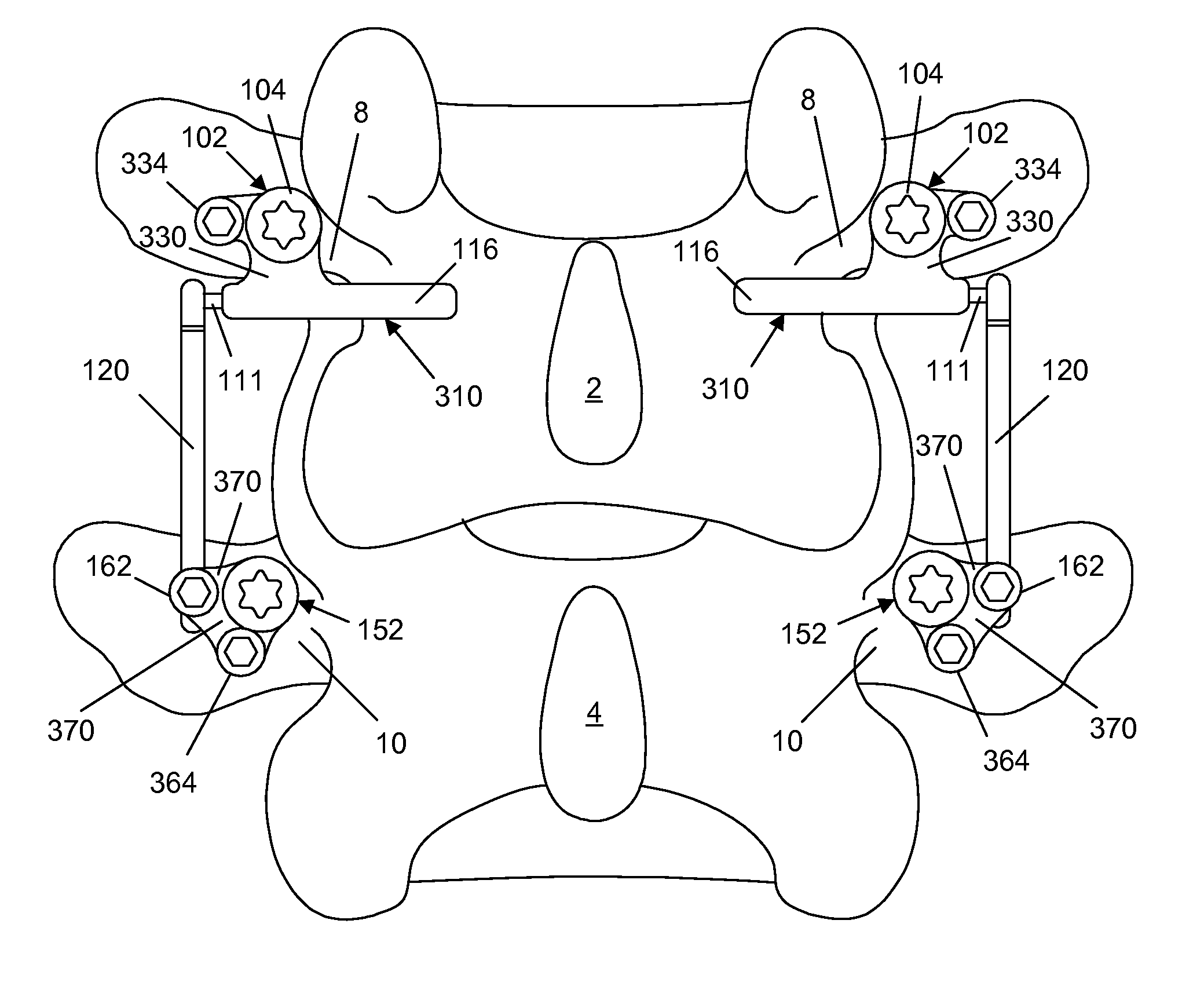 Spine implant with a deflection rod system including a deflection limiting shield associated with a bone screw and method