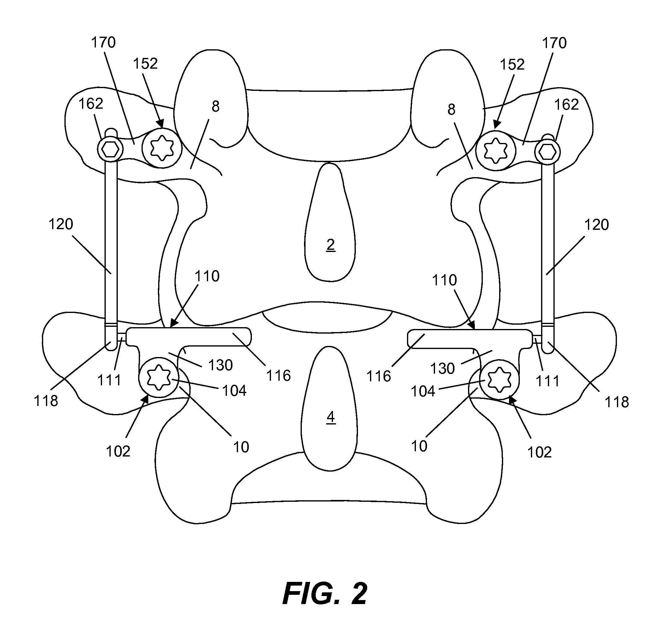 Spine implant with a deflection rod system including a deflection limiting shield associated with a bone screw and method
