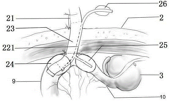 Functional enterostomy cannula