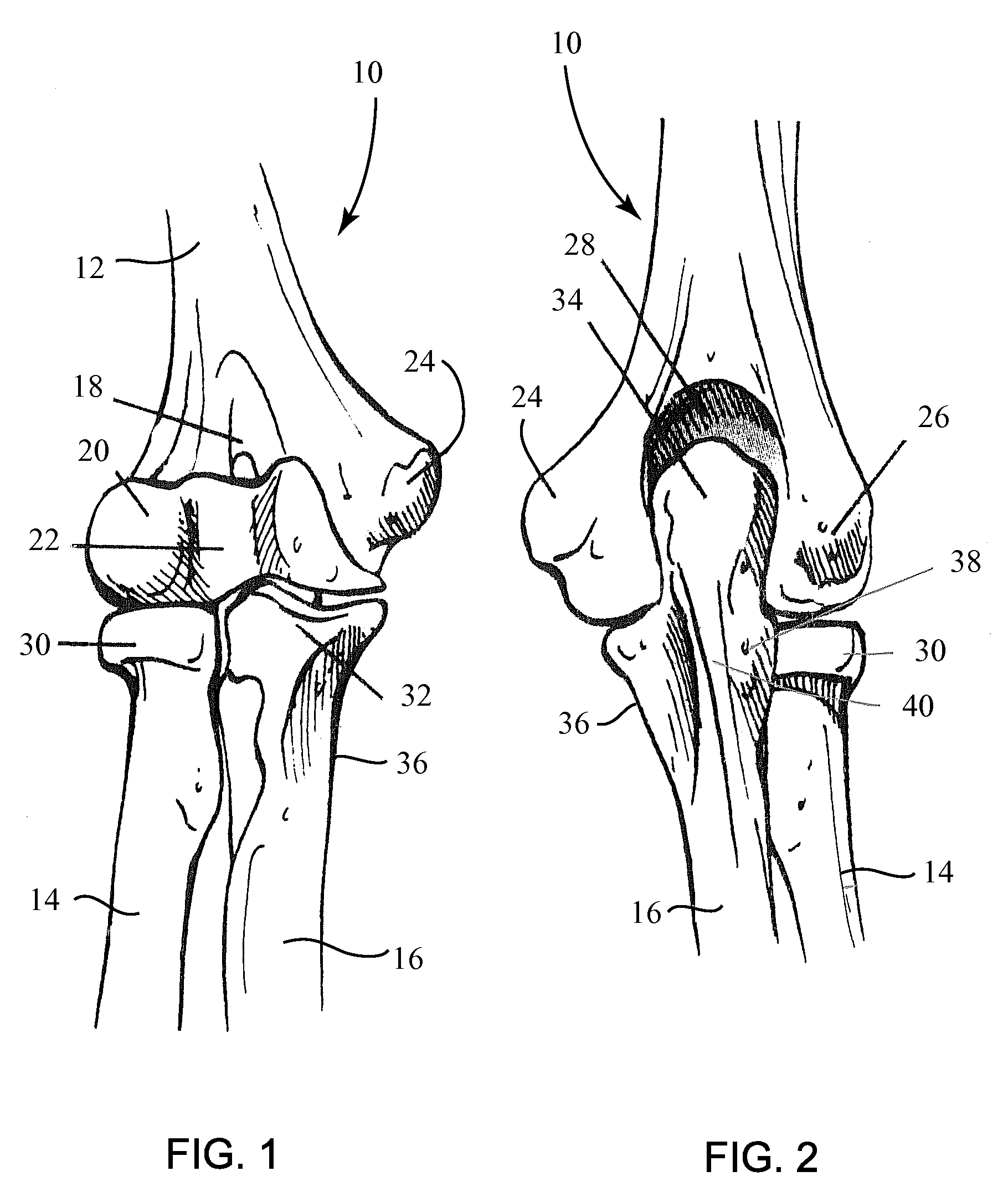 Fracture Fixation Plate for the Olecranon of the Proximal Ulna