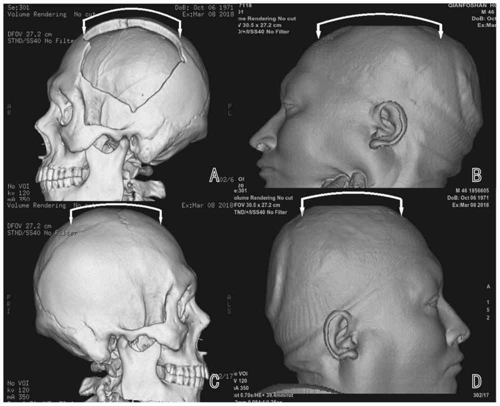 A 3D printed skull craniectomy bone window protection device after decompressive surgery and its preparation method