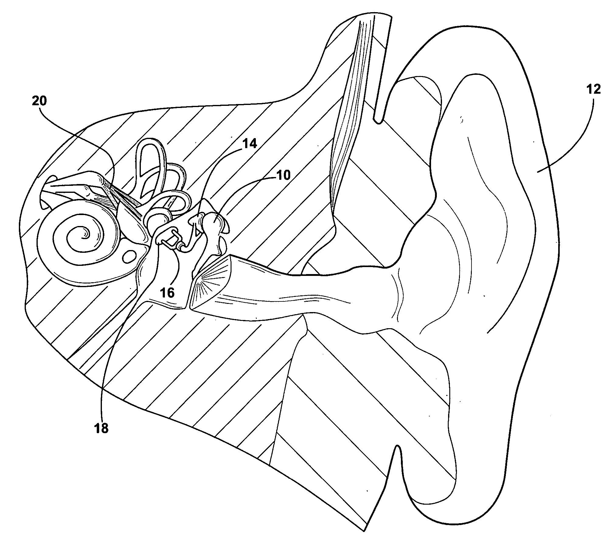 Middle ear reconstruction process and apparatus for performing the process