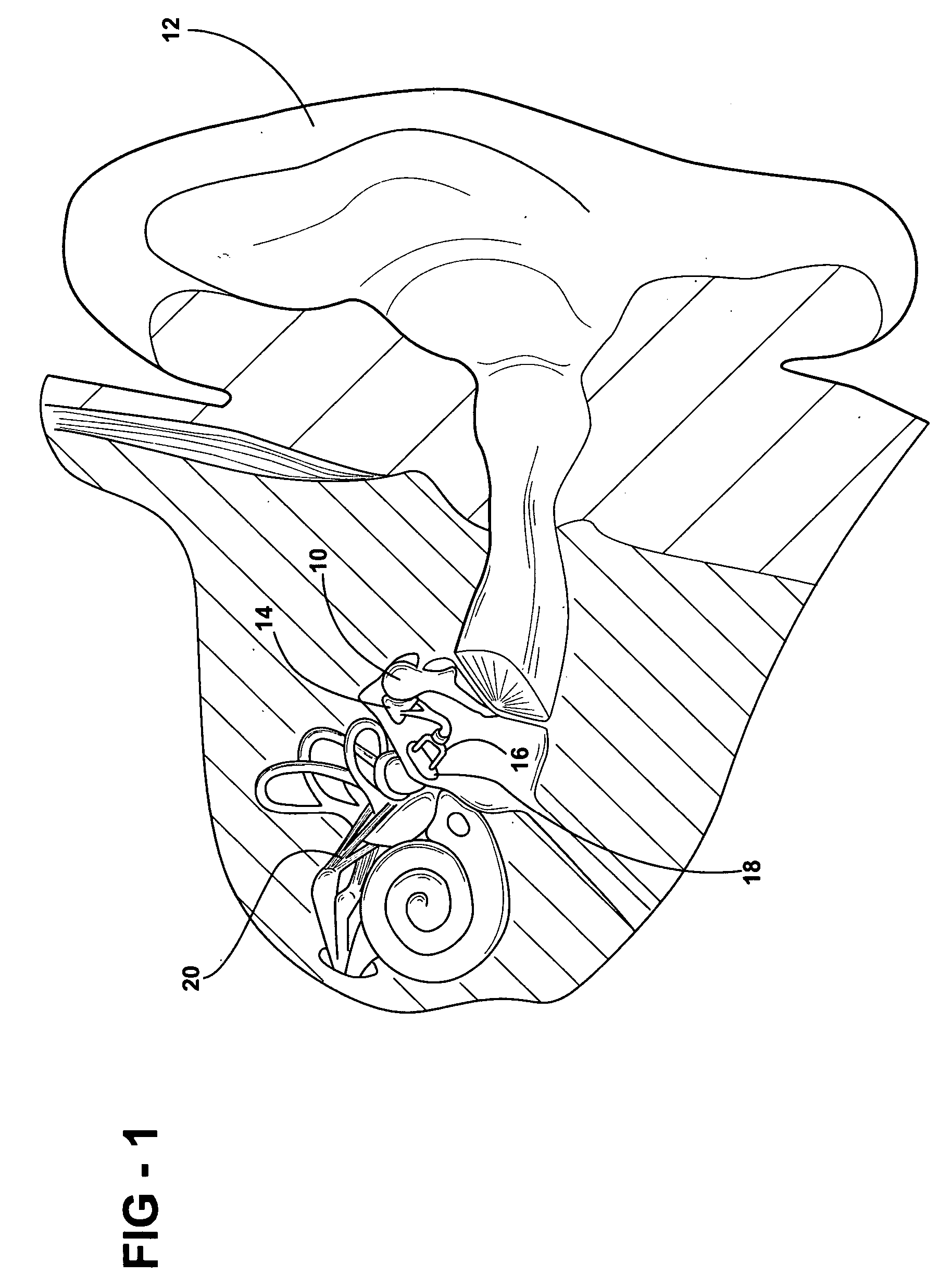Middle ear reconstruction process and apparatus for performing the process