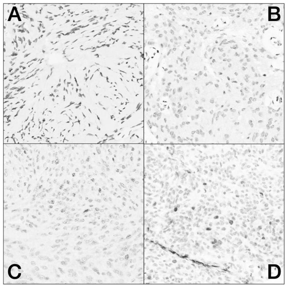 Application of BUB1 protein in preparation of high-grade meningioma prognosis evaluation reagent or kit