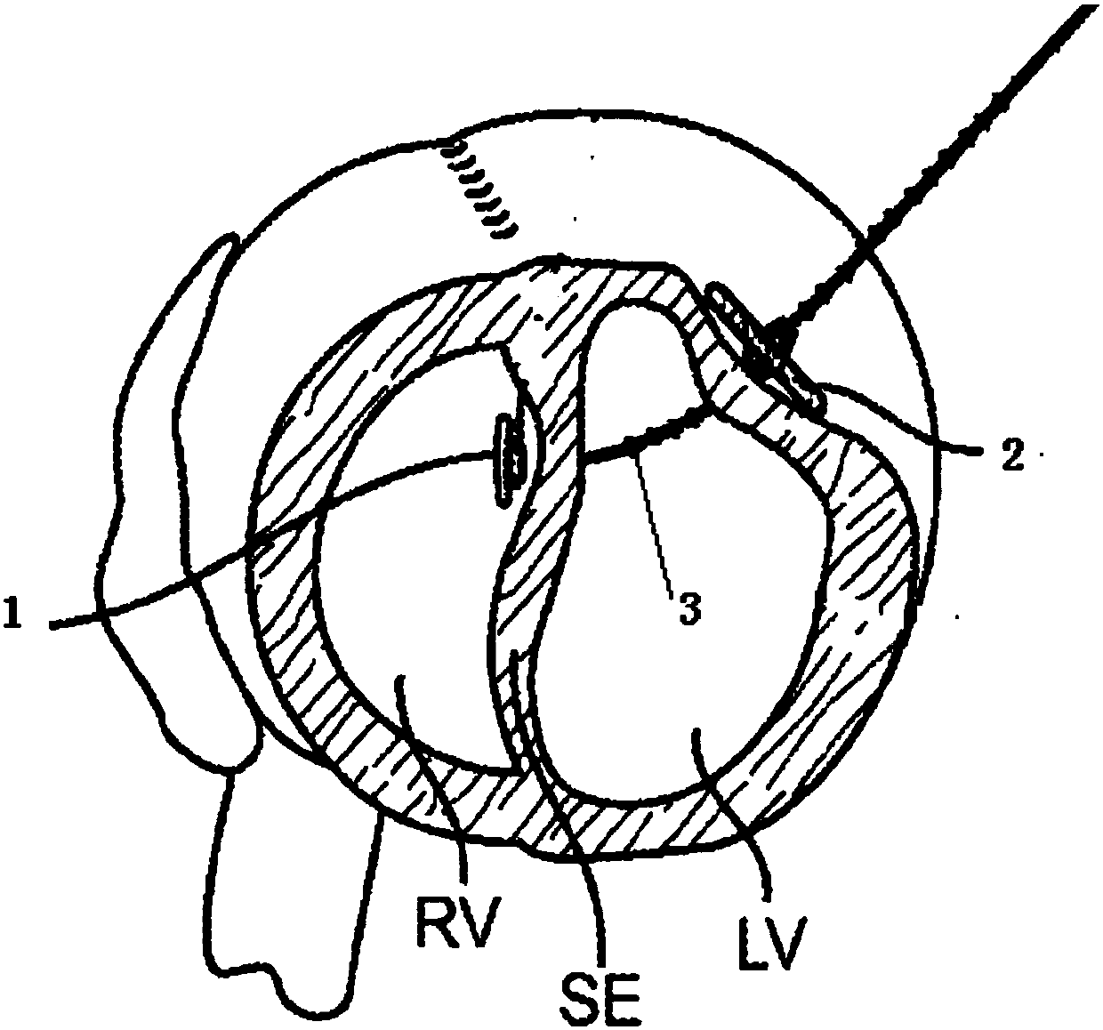 Medical device