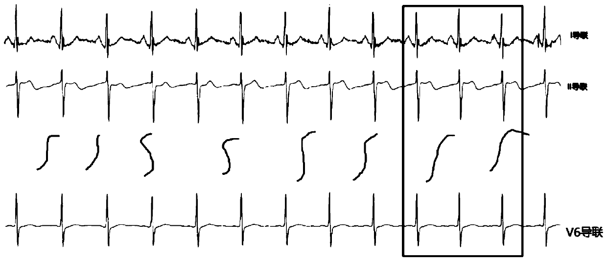 Atrial fibrillation monitoring method based on ECG signals