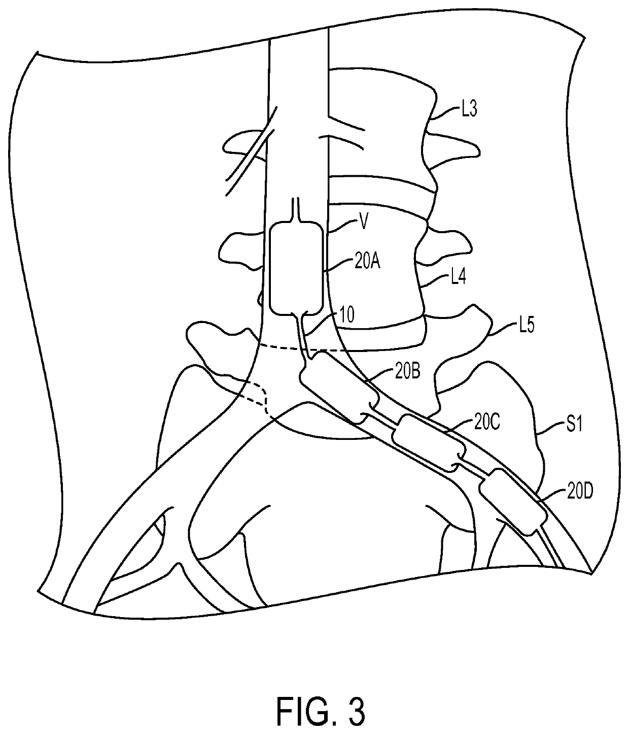 Multiple balloon venous occlusion catheter
