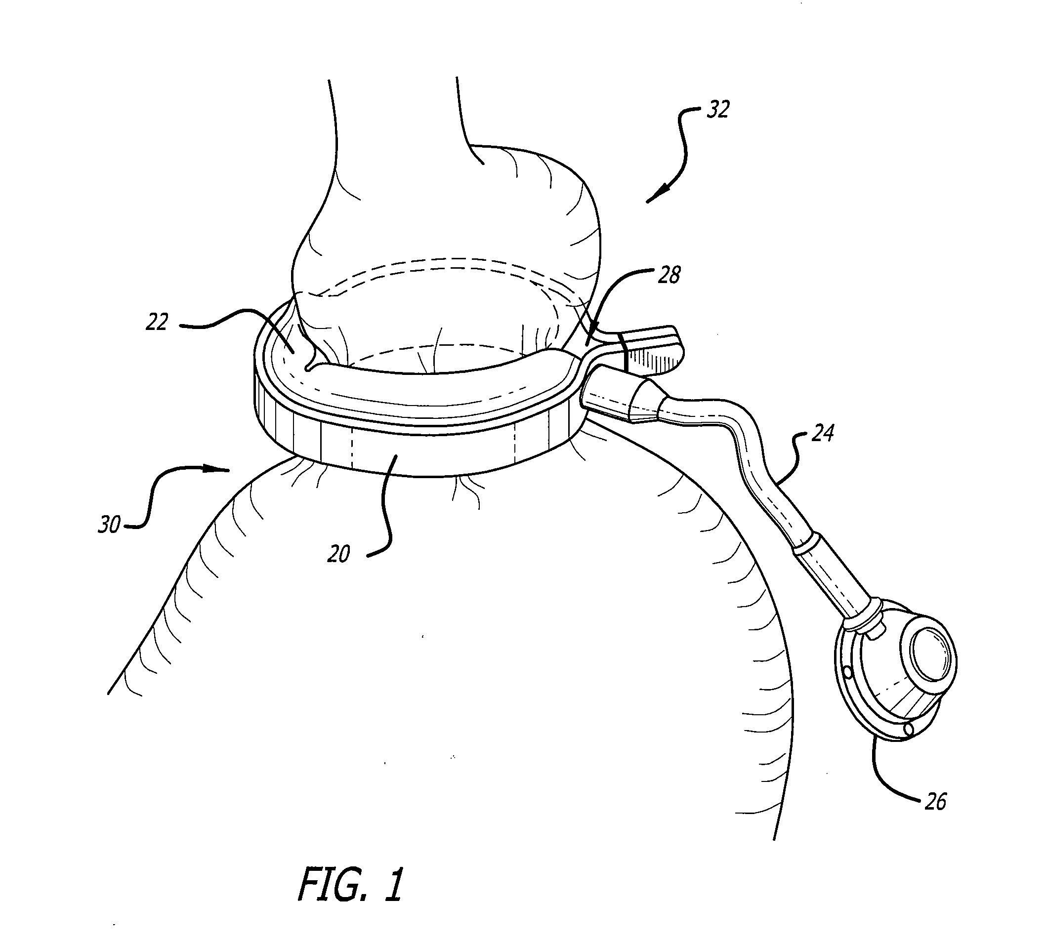 Assembly and method for automatically controlling pressure for a gastric band