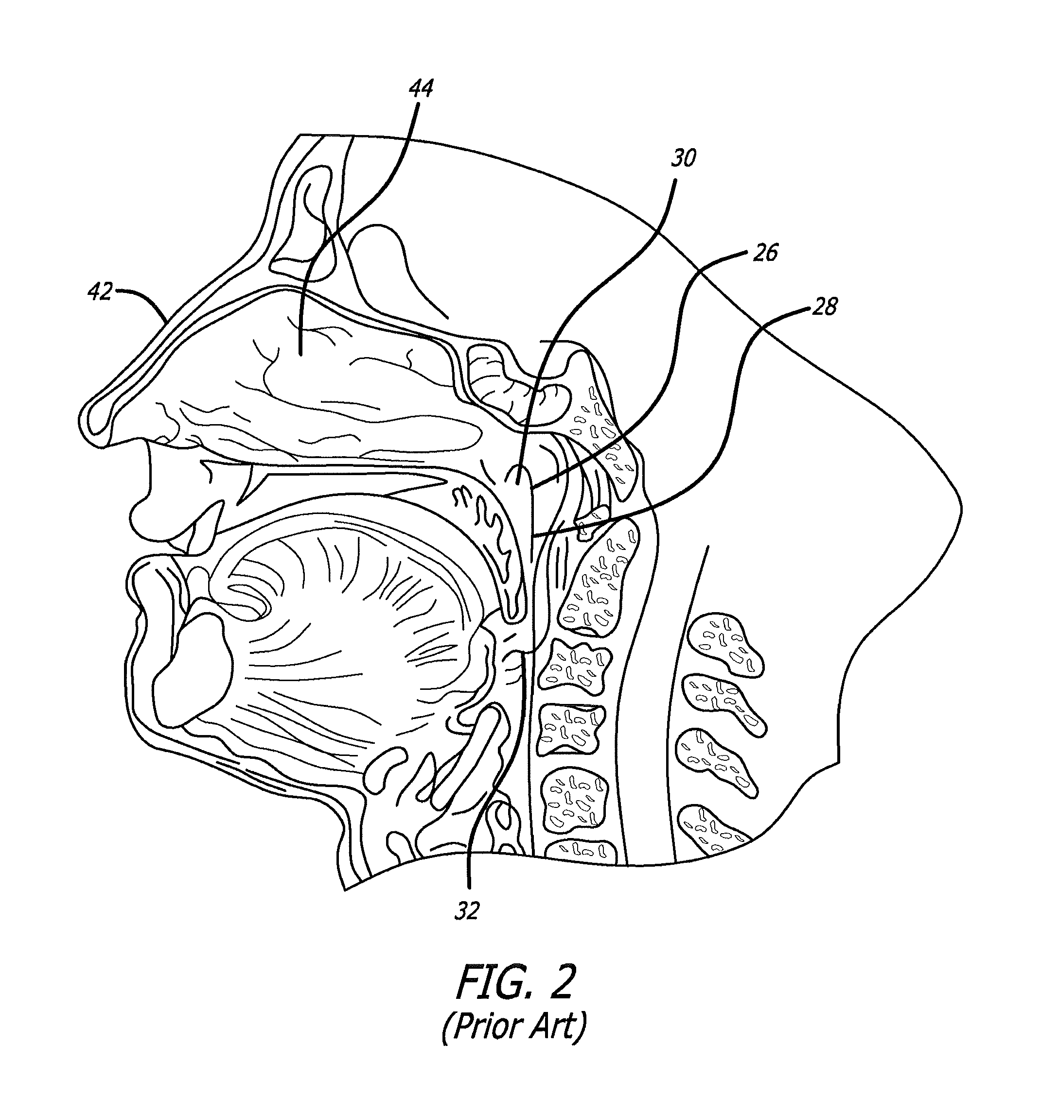System and method for treatment of non-ventilating middle ear by providing a gas pathway through the nasopharynx