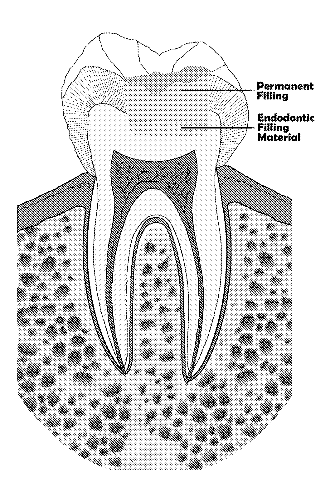 Endodontic filling material