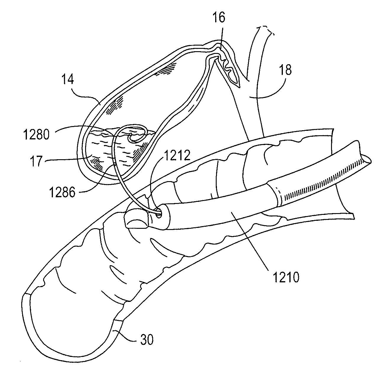 Biliary shunts, delivery systems, and methods of using the same