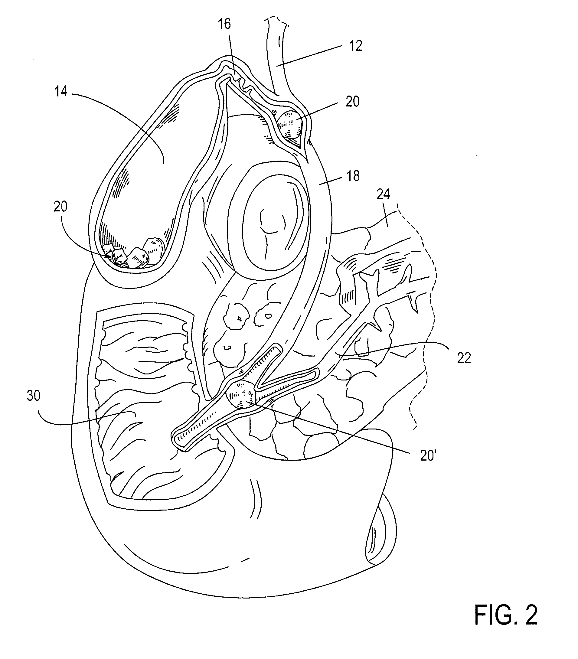 Biliary shunts, delivery systems, and methods of using the same