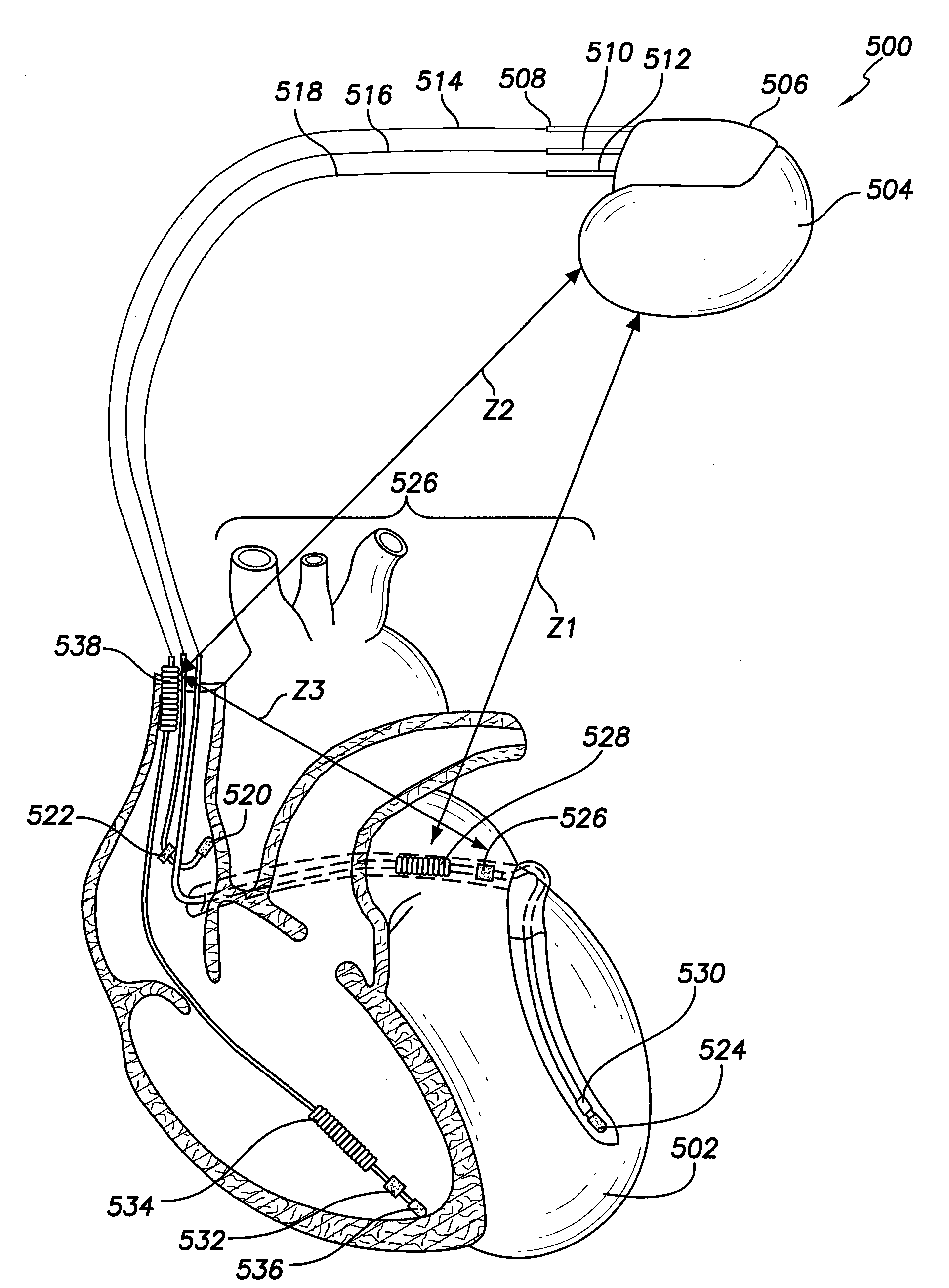 Method and system for discriminating and monitoring atrial arrhythmia based on cardiogenic impedance
