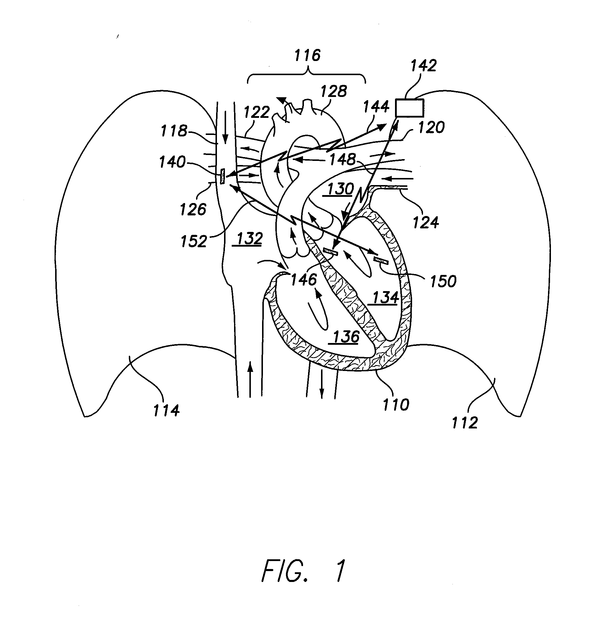 Method and system for discriminating and monitoring atrial arrhythmia based on cardiogenic impedance
