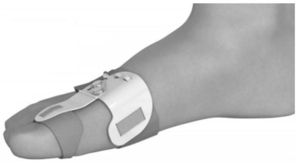 A rigid-flexible coupling hallux valgus orthosis